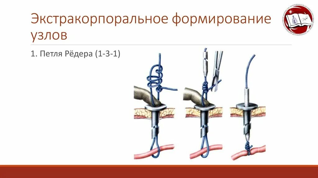 Схема узлов прямой узел. Развитие лимфатических узлов. Источник развития лимфатических узлов. Техника завязывания , морской узел хирургический узел. Развитие лимфоузлов гистология.