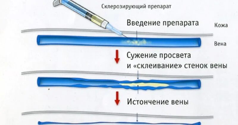 Лекарства для внутривенного введения. Шприц для внутривенных инъекций. Внутривенное вливание струйное. Лекарство не попало в вену. Внутривенная инъекция алгоритм выполнения.
