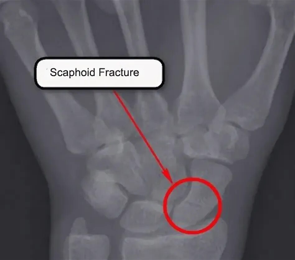 The fracture can be. Scaphoid and metacarpal fractures.
