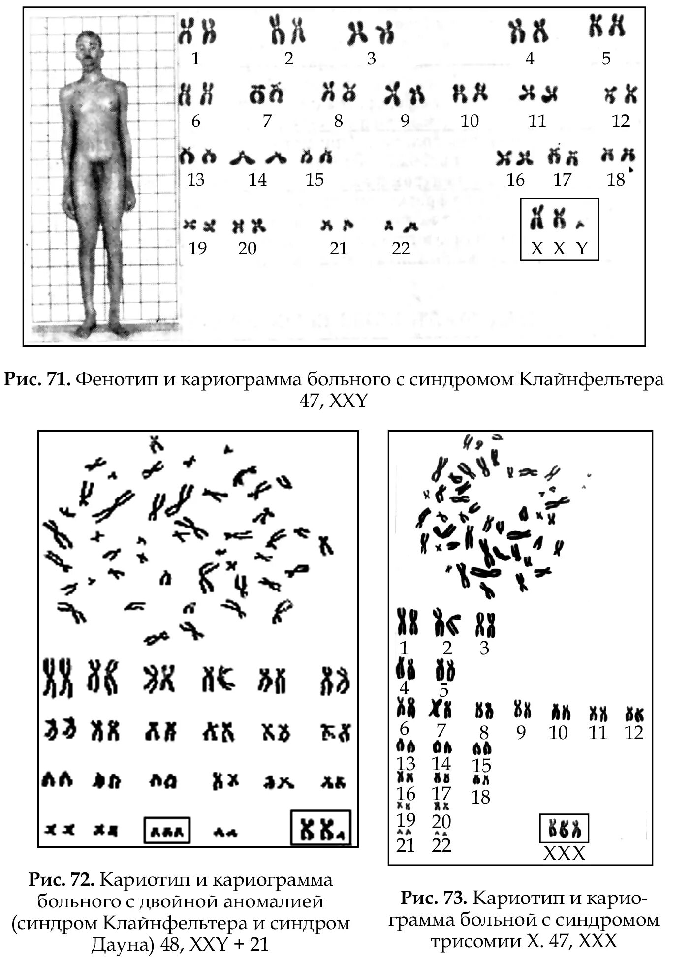 Кариотип человека определяют