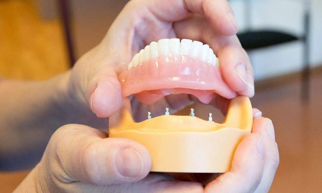 Пластиночный частичносъмный протез. Съемный пластинчатый протез (1 пластина). Флекс нейлоновый протез. Нейлоновый микропротез 1-3 зуба. Частичный съемный пластинчатый протез (1-3 зуба).