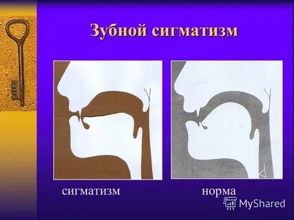 Что такое сигматизм