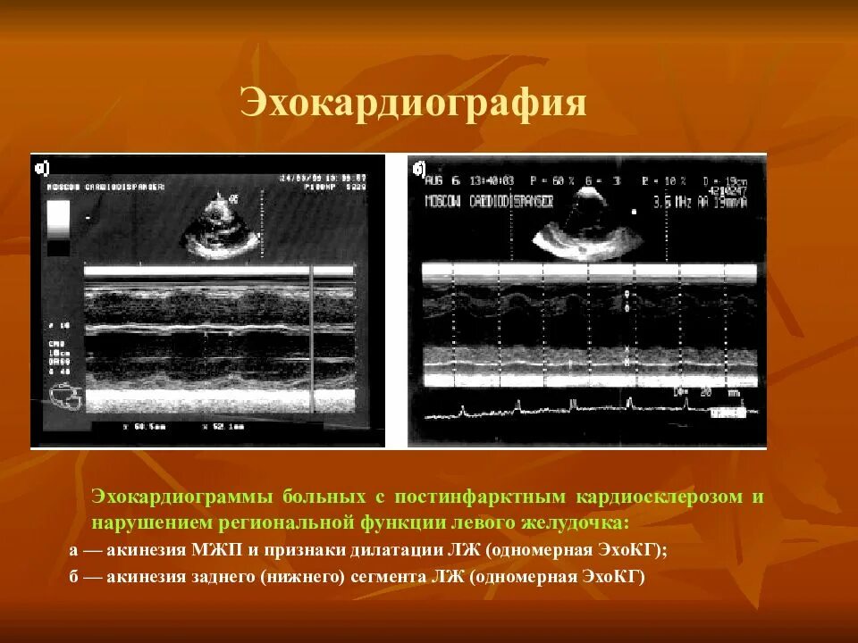 Постинфарктный кардиосклероз симптомы. Эхокардиография постинфарктный кардиосклероз. одномерная эхокг. одномерная эхокардиография. постинфарктный кардиосклероз на эхо кг.