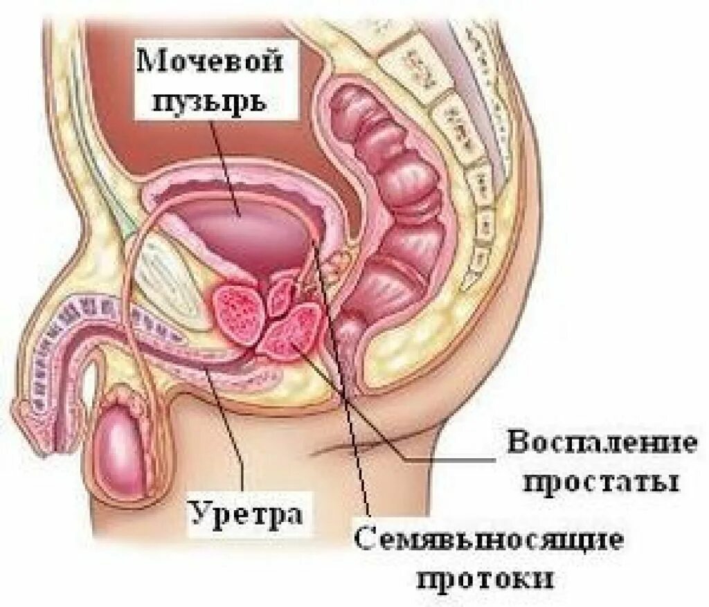 Воспалить простату. Воспаление простаты у мужчин.