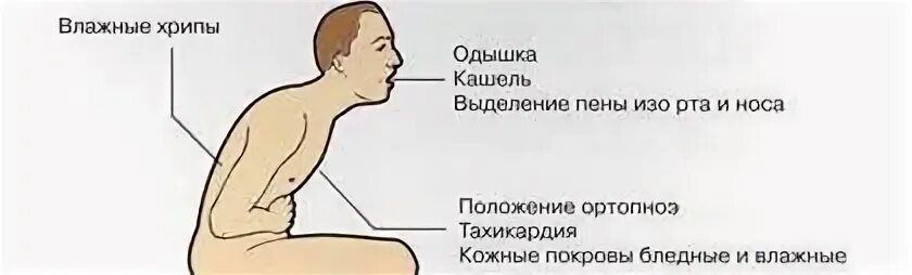 Симптом кашлевого толчка. Кашлевые толчки при бронхиальной астме. кашлевая зона у детей. астматический кашель симптомы у ребенка и признаки.
