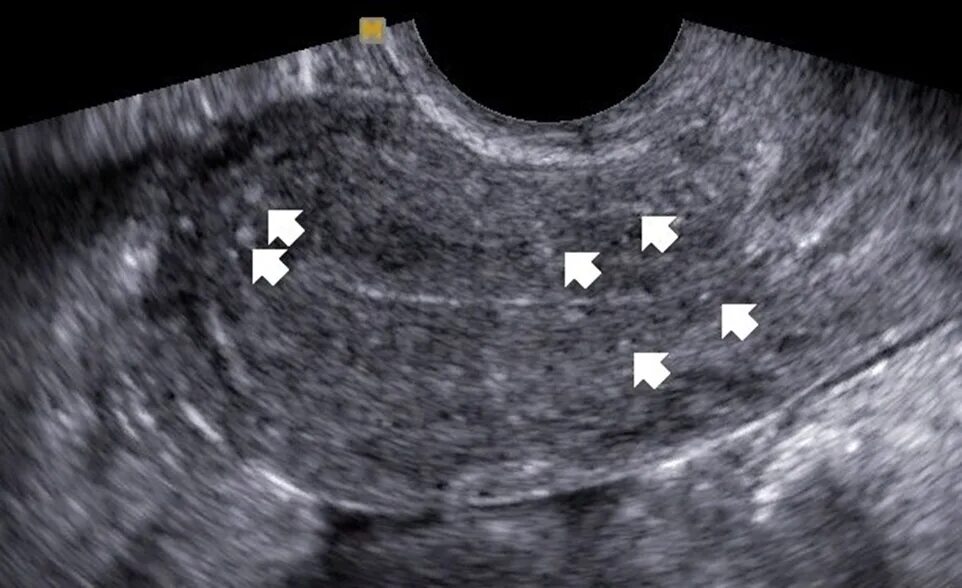Внутренний эндометриоз на УЗИ. Эндометриоз аденомиоз матки. УЗИ картина эндометриоза матки. Эхопризнаки аденомиоза что это
