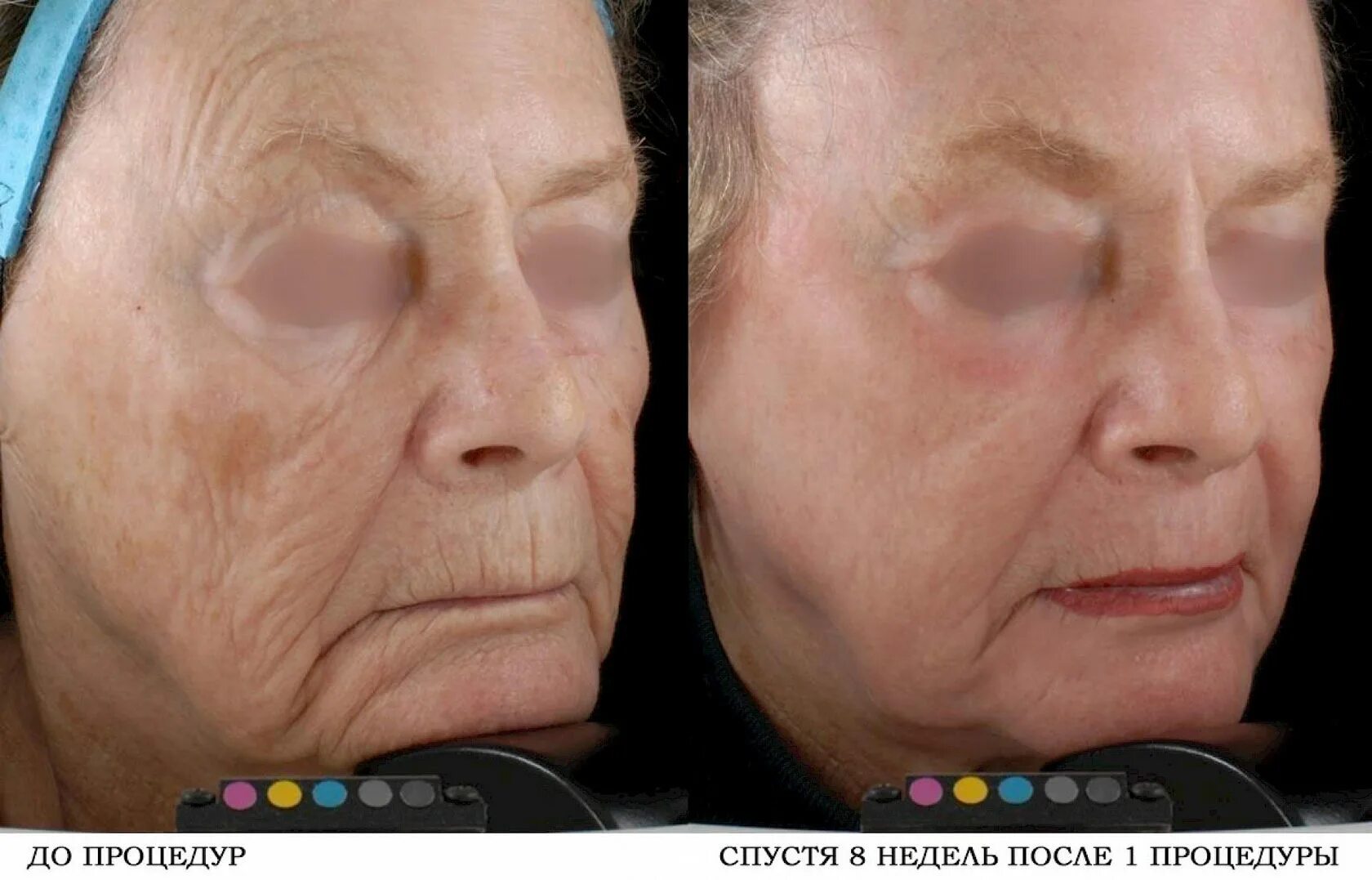 фракционный co2 лазер косметология. со шлифовка лица. со шлифовка лица. фракционный co2 лазер косметология. лазерное омоложение лица лоб.