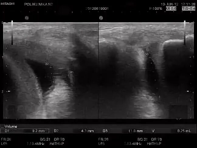 Эпикондилит локтевого сустава узи картина. Болезнь осгуда шлаттера мрт. Реактивный артрит коленного сустава мрт. Небольшое количество выпота в полости сустава. Выпот в полости сустава колена что это.