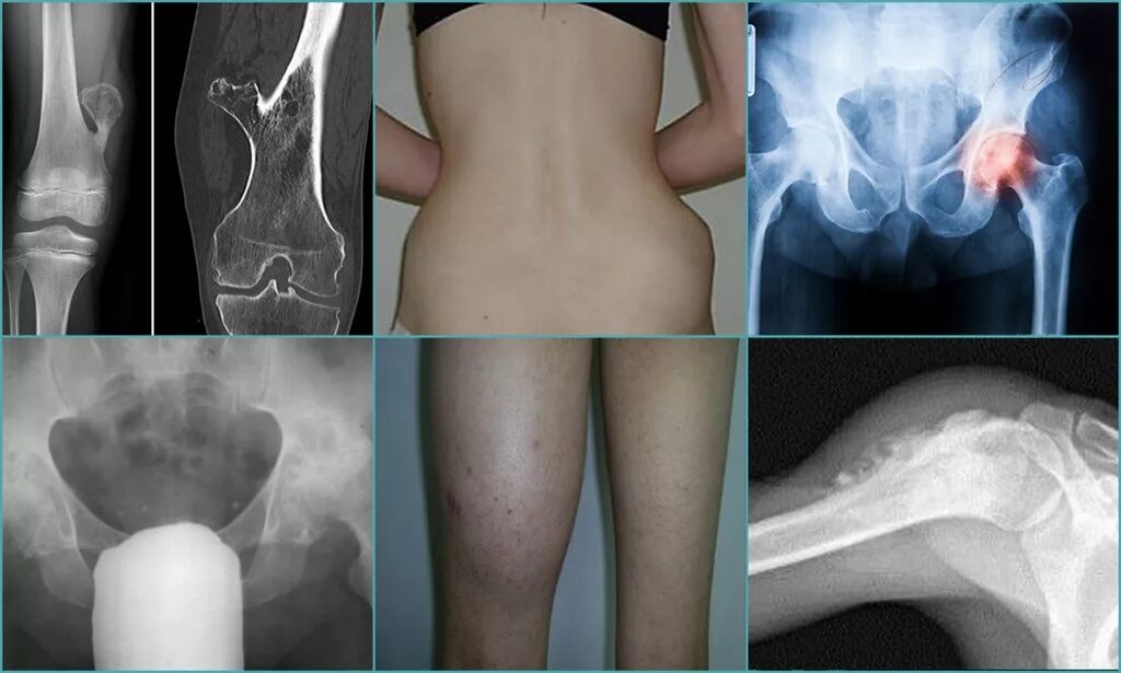 Болят кости после операции. Экзостоз тазобедренного сустава. Остеосаркома коленного сустава рентген. Остеохондрома плечевой кости. Хондросаркома тазобедренного сустава на рентгене.