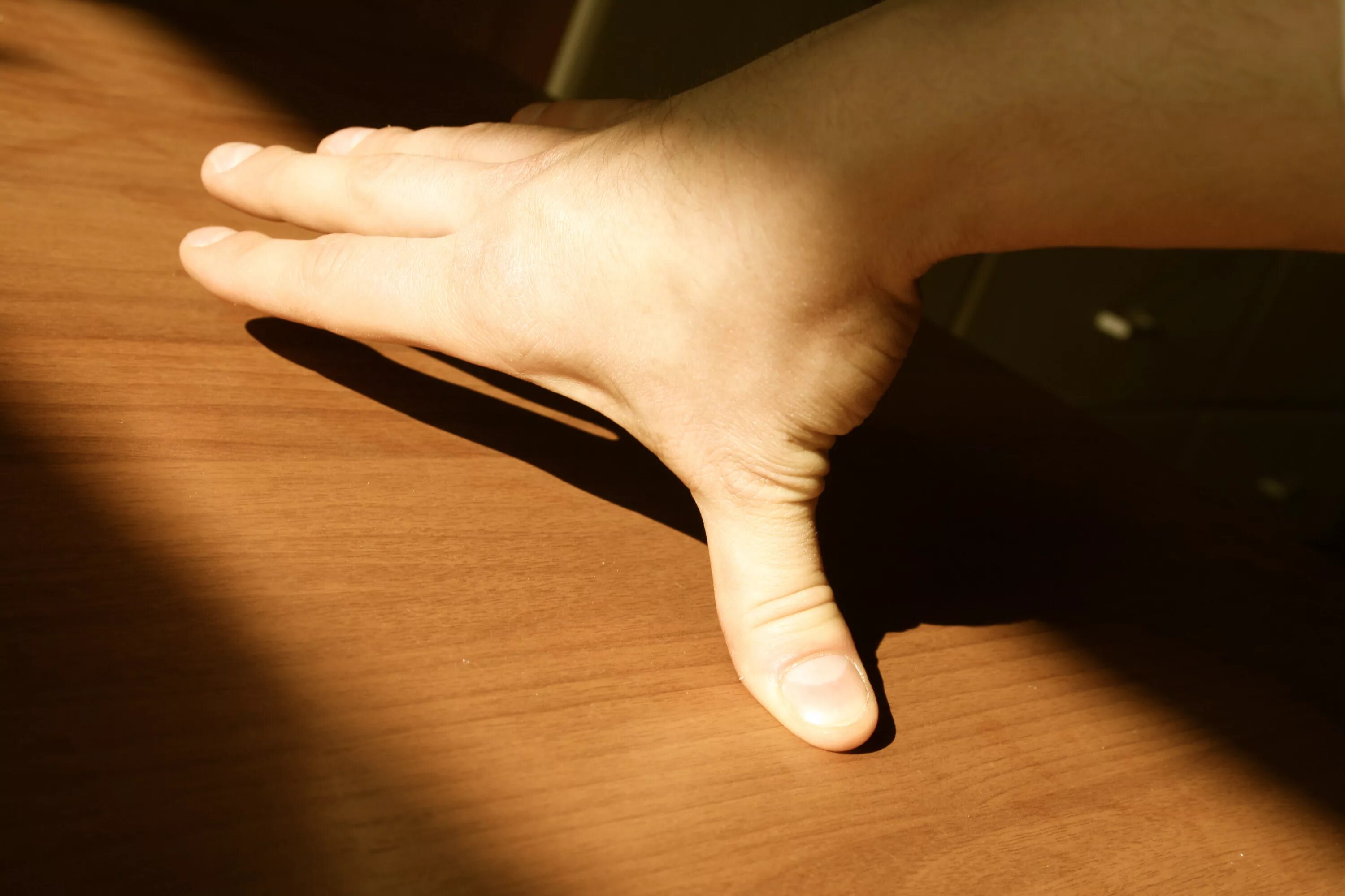 Разрыв сухожилия разгибателя 3 пальца кисти. Вывих дистальной фаланги пальца. Перелом сухожилия пальца. Отрыв сухожилия разгибателя пальцев кисти. Разрыв сухожилия пальца.