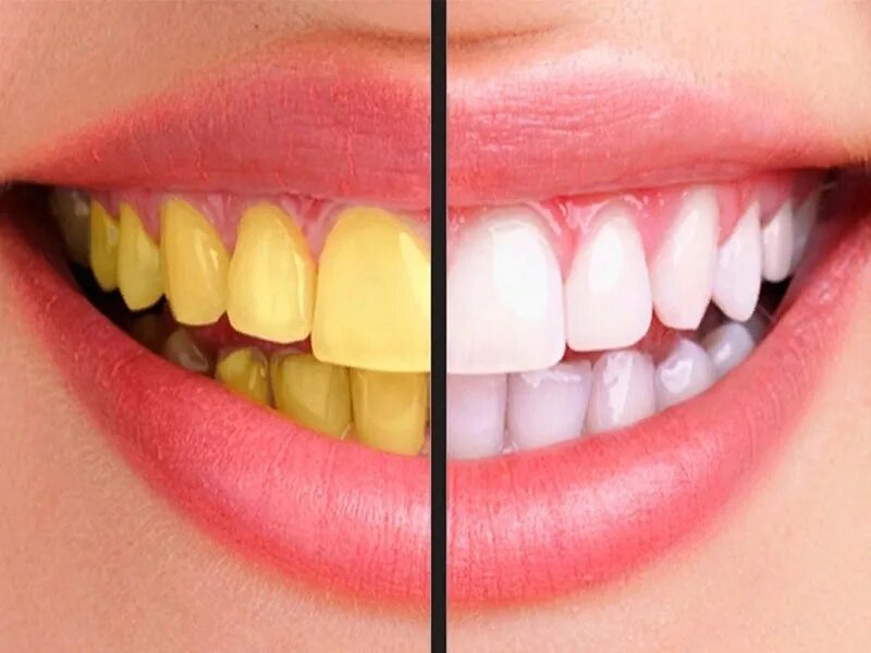 How Effective Are Teeth Whitening Strips? - Oris Dental Center