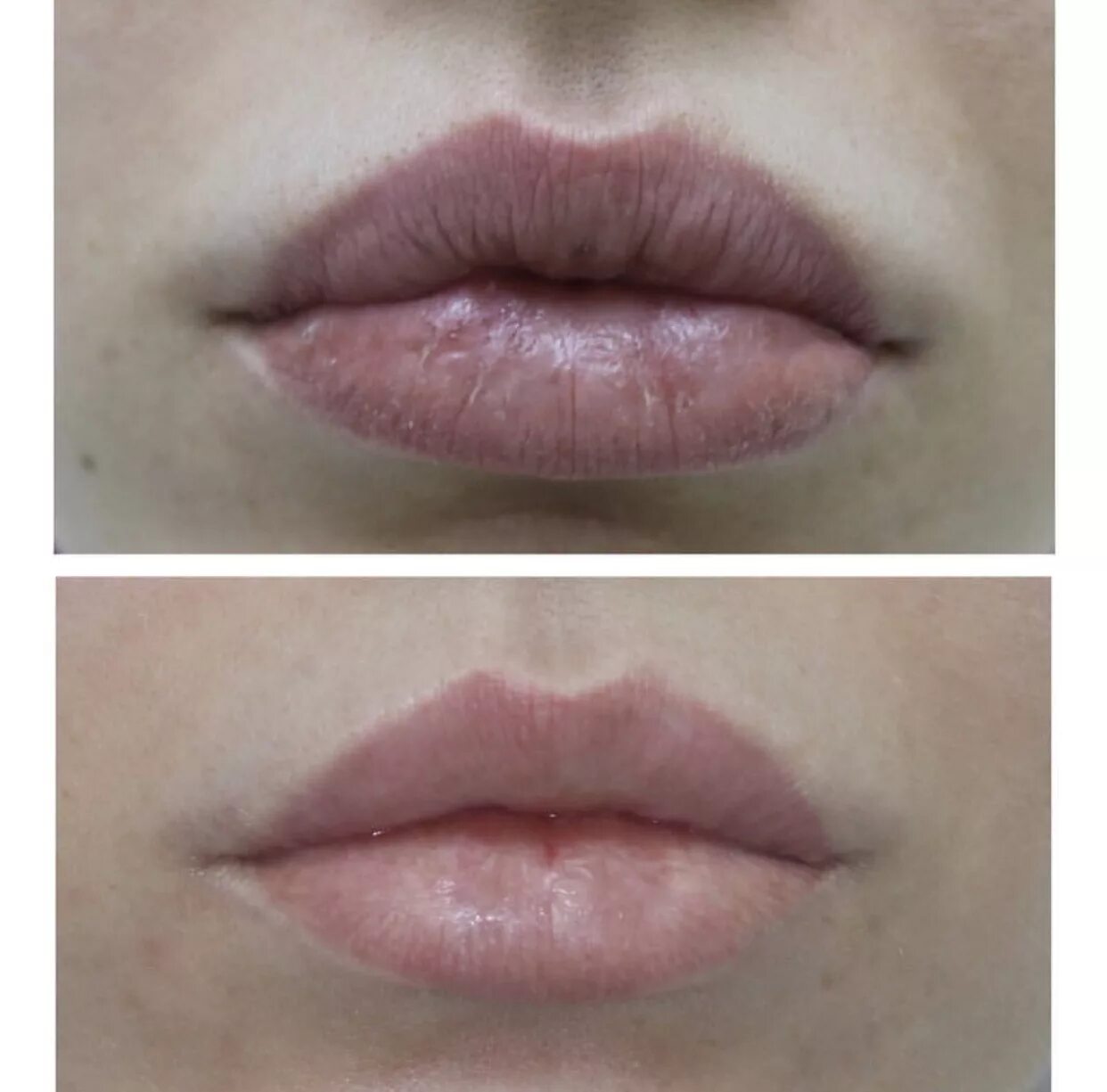 Ассиметрич верхней нубы. Увеличивание губ техника. Изменение формы губ. Губы после геля. Хейлопластика корнер лифт.