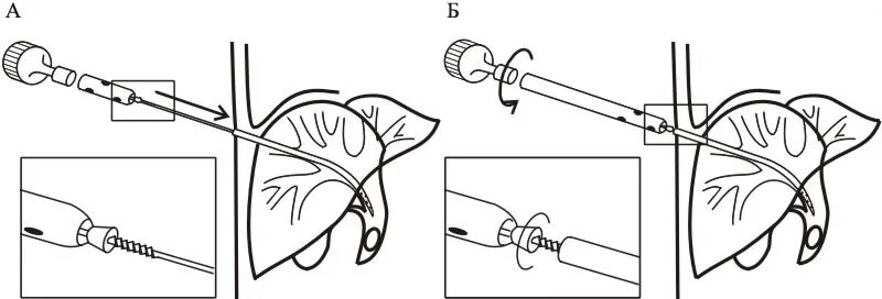 Чистка скважины эрлифтом. Проточно-промывная система для диализа раны. Дренажный катетер нефростома. Дренирование гнойных полостей. Как промывать дренаж.