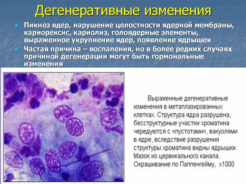 Реактивные изменения шейки. Клетки с дегенеративными изменениями. Дегенеративные нейтрофилы в цитологии. Дистрофические изменения клеток. Дегенеративные изменения эпителия.