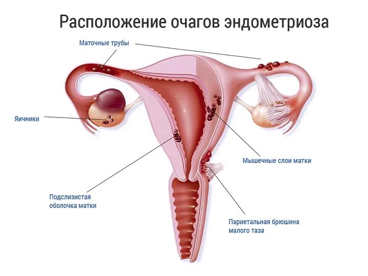 Эндометрий 30. Ретроцервикальный эндометриоз. Ретроцервикальный эндометриоз классификация. Эндометрит гинекология.
