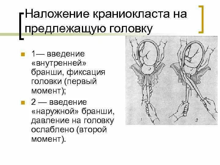 Разрушающие операции. Плодоразрушающие операции краниотомия. Плодоразрушающие операции декапитация. Плодоразрушающие операции в акушерстве клинические рекомендации. Краниотомия плода техника операции.