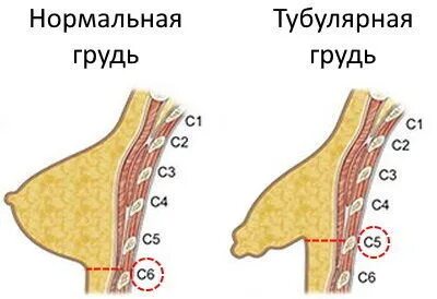Пластика груди у рожавших и нерожавших женщин: основные моменты Современный взгл