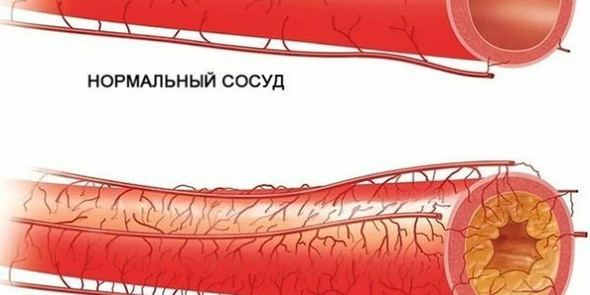 Расширение сосудов лечение. Чистые кровеносные сосуды. Сужение сосудов головного мозга. Расширение сосудов лечение. Расширение сосудов лечение.