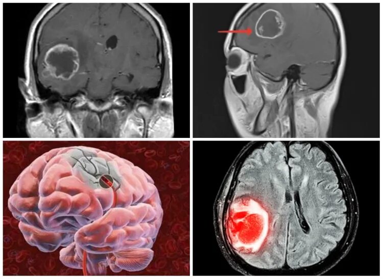 Brain 164. Опухоль головного мозга глиобластома 4. Глиобластома лобной доли. Мультиполярная глиобластома 4 степени. Неоперабельная опухоль мозга глиобластома.