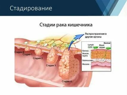 Опухоль прямой кишки стадии