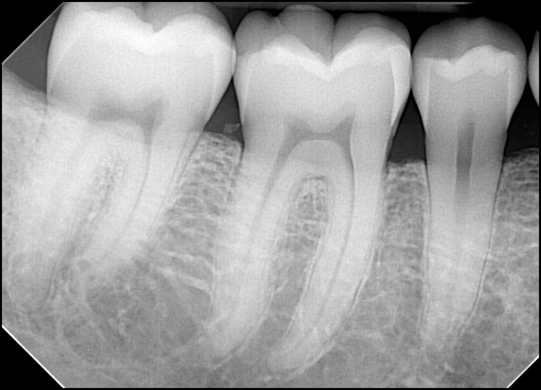 Снимок. Радиовизиография пульпит 36. Dental визиограф XRAY. Внутриротовая прицельная рентгенограмма.