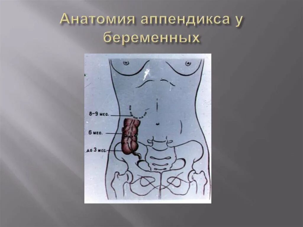 Колики аппендицит. Скелетотопия аппендикса. Анатомическое расположение аппендикса. Анатомия аппендикса расположение.