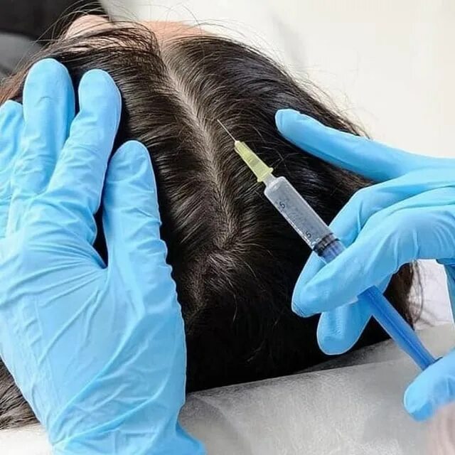 Мезотерапия месячных. Мезотерапия кожи головы. мезотерапия для волос. мезотерапия кожи головы фото. мезотерапия волосистой части головы препараты.