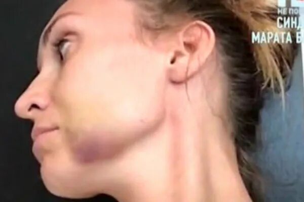 жена нанесла телесные повреждения