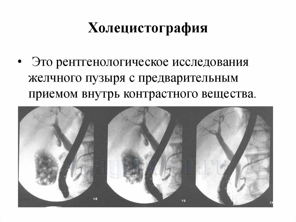 Пероральная холецистография. Рентгенологические исследования (холецистография, холангиография):. Хронический холецистит холецистография. Ультразвуковая динамическая холецистография. Рентген исследование желчного пузыря.