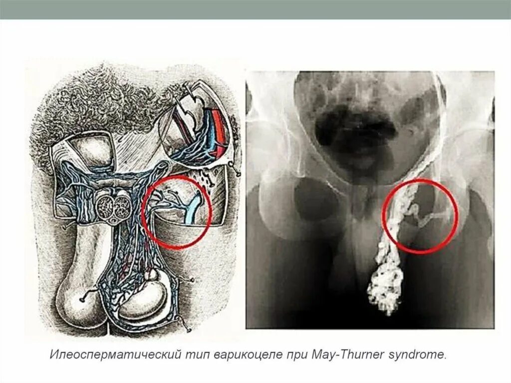 Операция семенной канатик. Варикоцеле варикозное расширение вен. Варикозное расширение вен семенного канатика III степени. Варикозное расширение вен семенноготканатика. Расширение вены семенного канатика