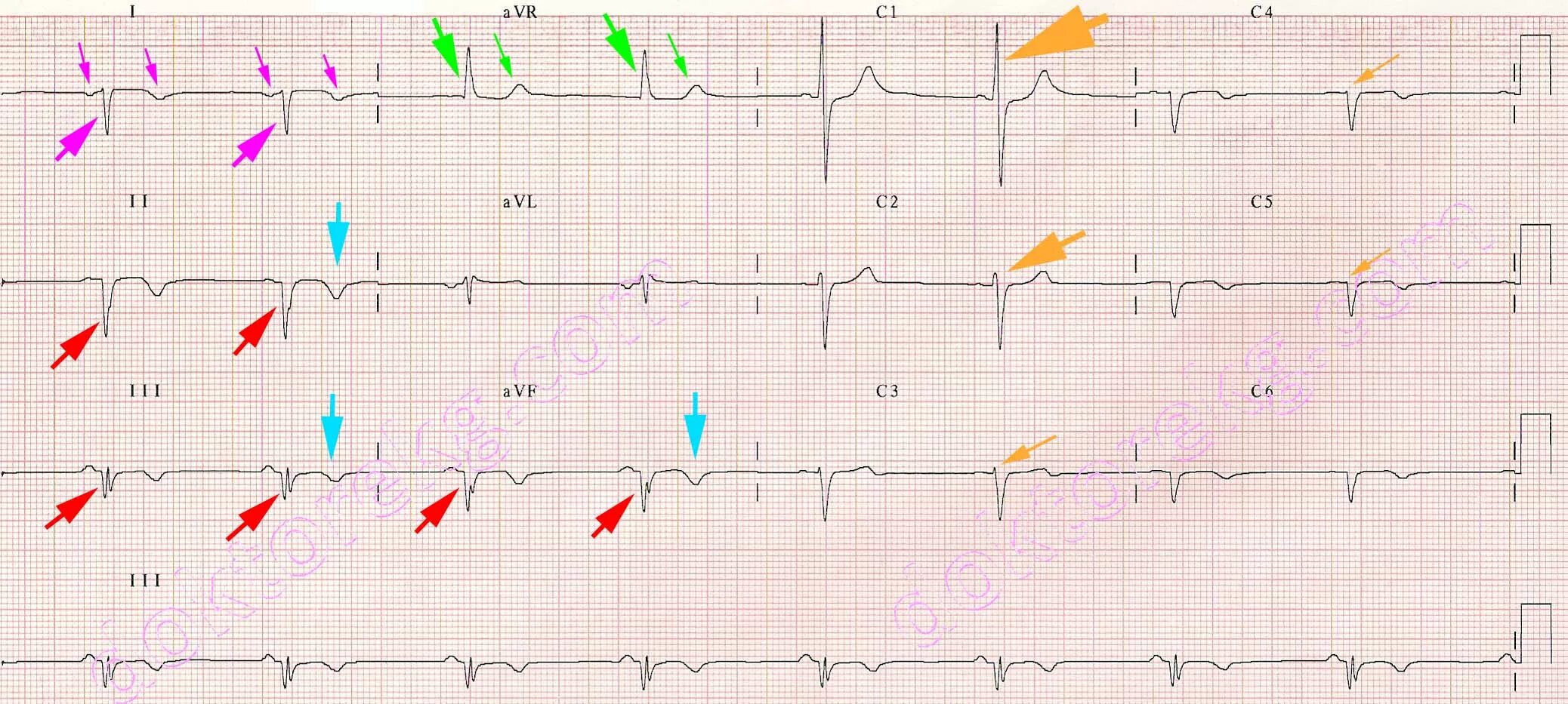 Кардиограмма сердца пример. Кардиограмма сердца пример. Пример нормальной экг. Экг норма расшифровка кардиограммы. 3 стандартное отведение экг норма.