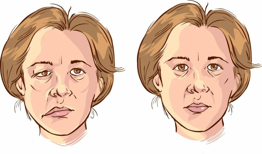 Девчонка парализованная. Асимметрия лица. Асимметрия лица при инсульте. Периферический паралич мимической мускулатуры. Девушка с парализованными ногами.