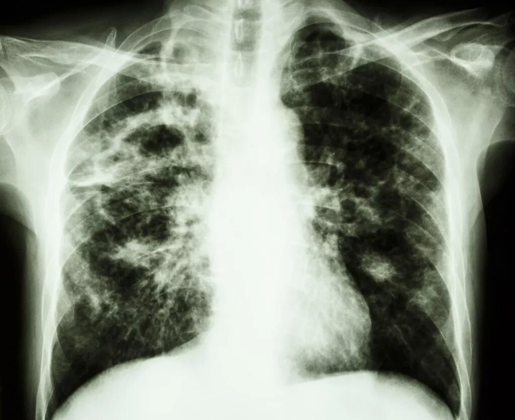 Легкие человека с туберкулезом. Туберкулез легких рентген. Рентгенография грудной клетки туберкулез. Рентген грудной клетки туберкулез. Рентгенограмма грудной клетки туберкулез.