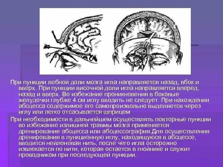 Пункционная аспирация абсцесса мозга. Дренирование абсцесса головного мозга. Абсцесс лобной доли мозга симптомы.