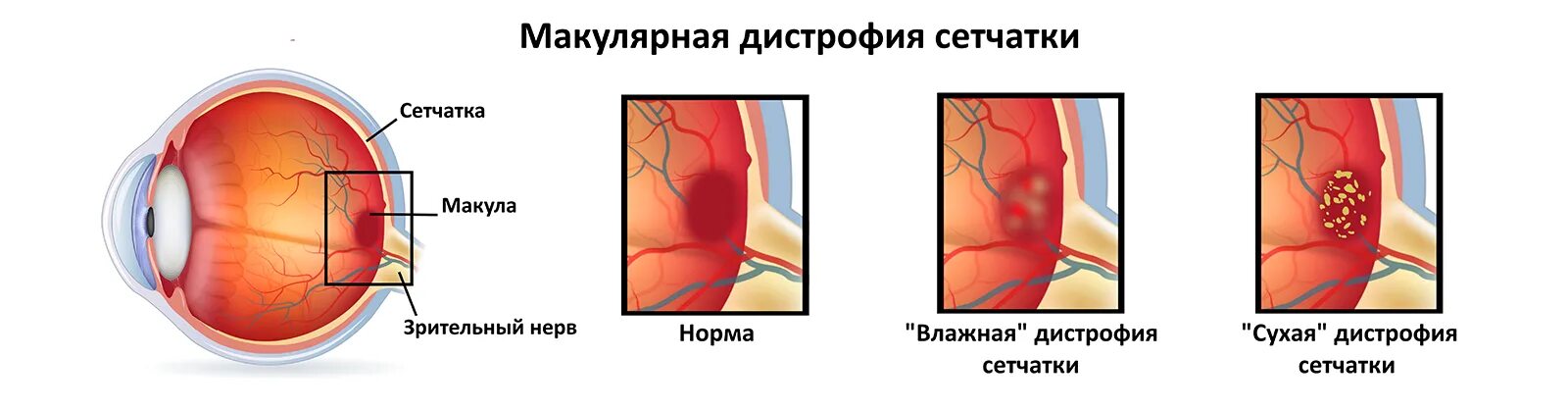 Отслойка сетчатки лазерная коагуляция. Разрыв сетчатки лазерная коагуляция. Отслойка сетчатки операция лазером. Лазерной коагуляции сосудов сетчатки.