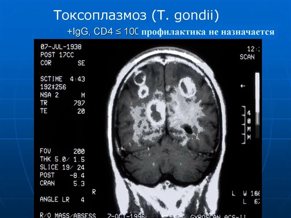 Токсоплазмоз у вич инфицированных. Токсоплазмоз гонди. латентный токсоплазмоз. кт головного мозга при токсоплазмозе.