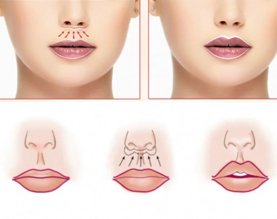 Пластика губ кессельринг. Хейлопластика верхней губы. Хейлопластика булхорн. Хейлопластика верхней губы. Хейлопластика булхорн.