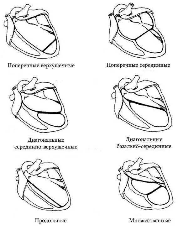 Наличие хорды у человека. Дополнительная хорда в сердце. Дополнительная корда в сердце. Дополнительная хорда в сердце у ребенка. Дополнительная хорда в левом желудочке сердца.