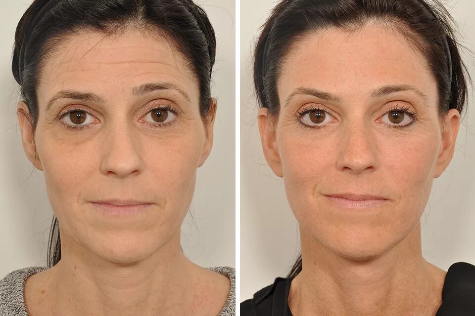 Brow lifting. Броулифтинг. Подтяжка бровей броулифтинг.