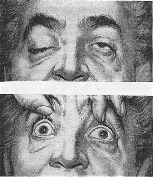 Гиперсомническая офтальмоплегия. Синдром офтальмоплегия (наружная, внутренняя, тотальная). Прогрессирующие офтальмоплегии. Прогрессирующая надъядерная офтальмоплегия. Наружная офтальмоплегия симптомы.