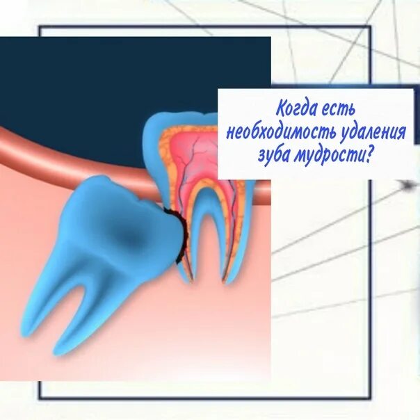 Сколько нельзя кушать после удаления. Удалённый зуб мудрости. Воспаление капюшона зуба мудрости.