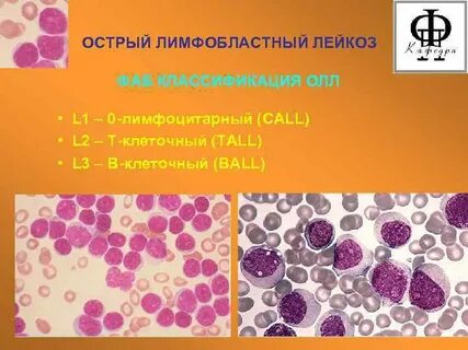 Острый лейкоз олл