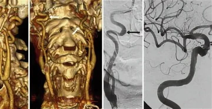 Изгиб вса. Кинкинг позвоночной артерии мрт. Извитость сонных артерий кинкинг. Патологическая извитость сонных артерий койлинг. Патологическая извитость позвоночной артерии.