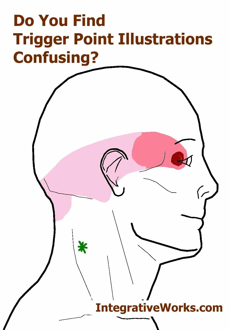 Отдает в глаз. Мигрень акупунктурные точки. Головная боль триггерные точки. Триггерные точки головная боль мигрень. Точки для облегчения головной боли.