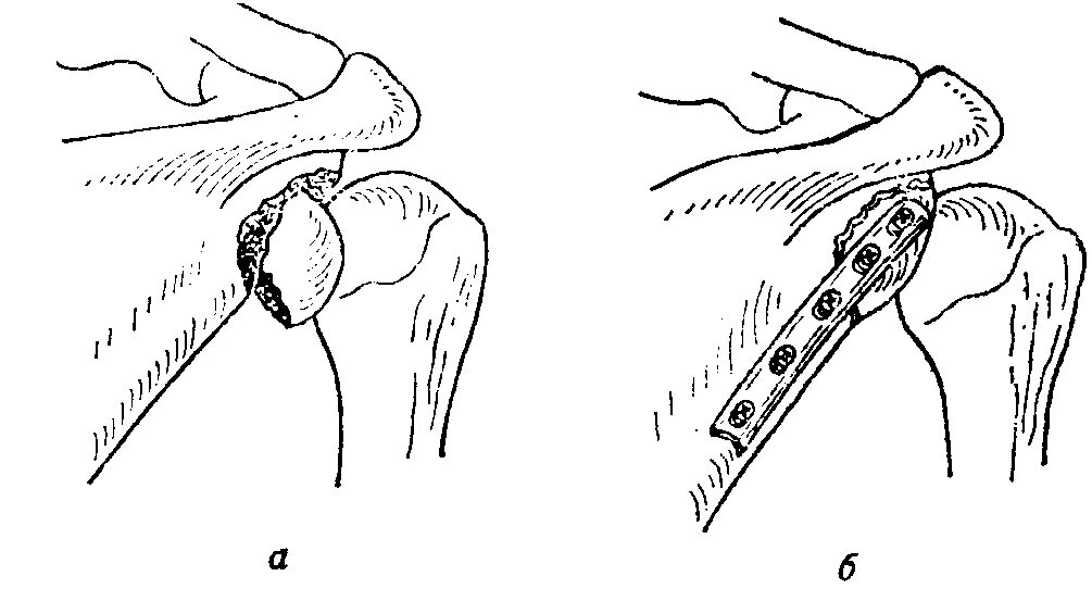Перелом лопатки остеосинтез. Остеосинтез суставной поверхности лопатки. Перелом лопатки пункция. Остеосинтез шейки лопатки.