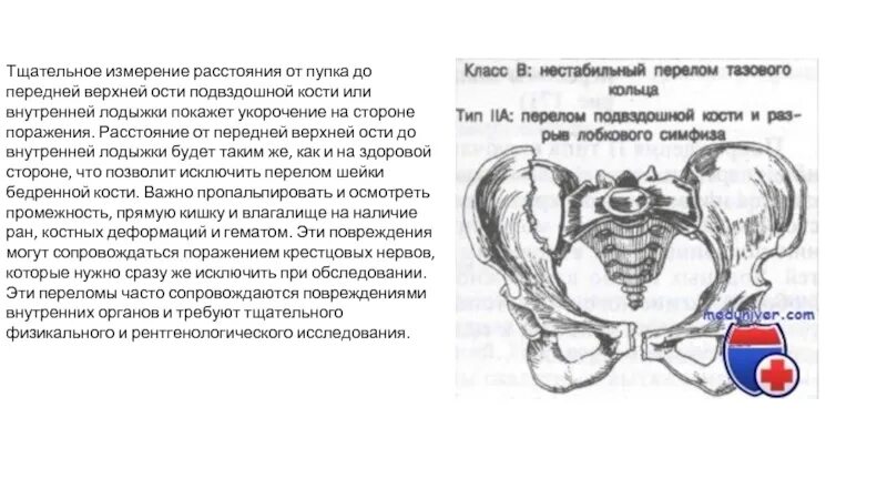 Верхняя передняя подвздошная кость. Передней верхней подвздошной ости. Перелом передней верхней ости подвздошной кости. Передняя верхняя ость подвздошной кости. Перелом передне верхней ости.