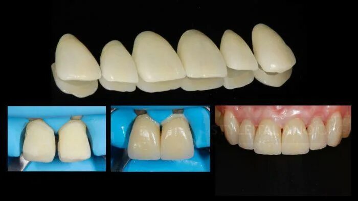 Материал для реставрации зубов. Адгезивный протокол фиксации керамических коронок. Композиты для фронтальной группы зубов. Адгезивная фиксация виниров. Композитный винир Щербаков.