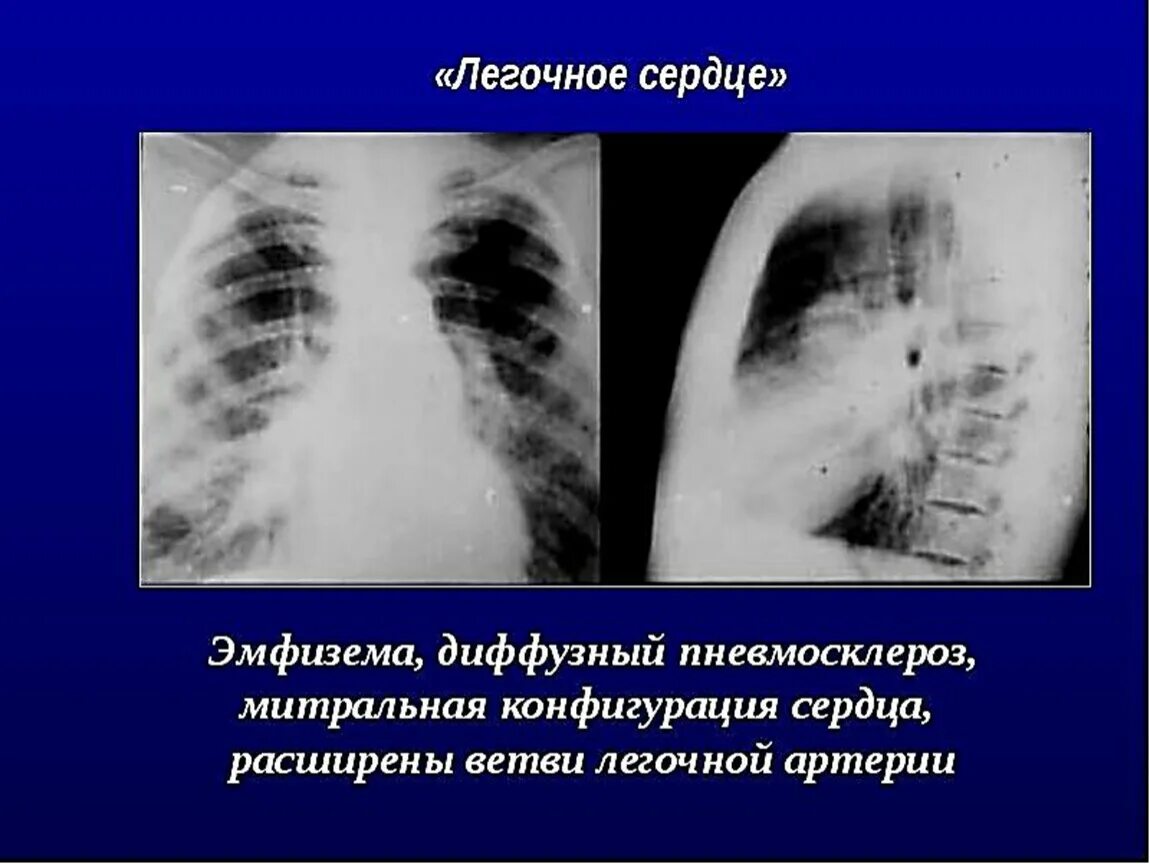 Хроническое легочное сердце рентген. Легочное сердце на рентгенограмме. Рентгенография при легочном сердце. Легочная конфигурация сердца. Пневмосклероз это простыми словами