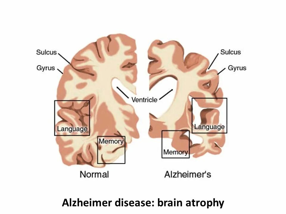 Б альцгеймера. Болезнь альцгеймера. деменция. alzheimer.