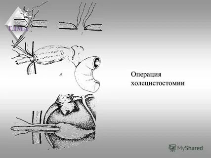 Холецистостомия операция